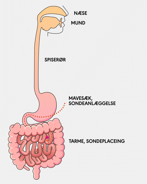 animation showing the placement path of a GJ tube