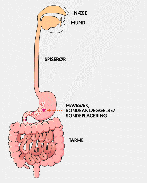 animation showing the placement path of a G tube