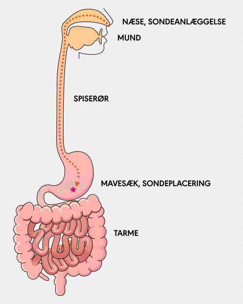 animation showing the placement path of an NG tube