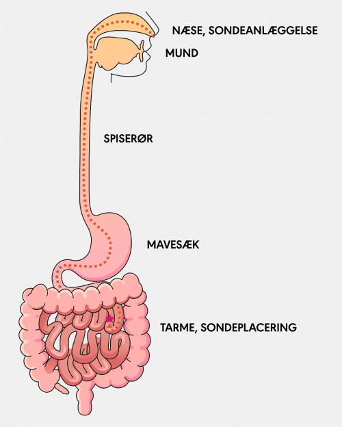 animation showing the placement path of an NJ tube